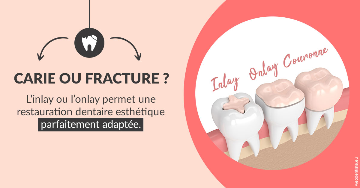 https://dr-sebastien-ginfray.chirurgiens-dentistes.fr/T2 2023 - Carie ou fracture 2
