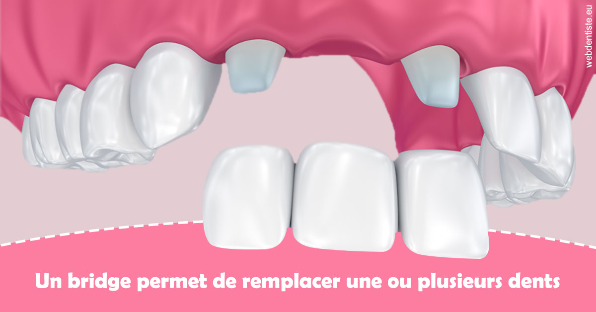 https://dr-sebastien-ginfray.chirurgiens-dentistes.fr/Bridge remplacer dents 2