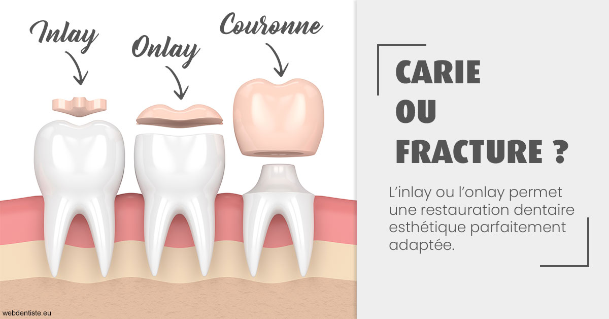 https://dr-sebastien-ginfray.chirurgiens-dentistes.fr/T2 2023 - Carie ou fracture 1