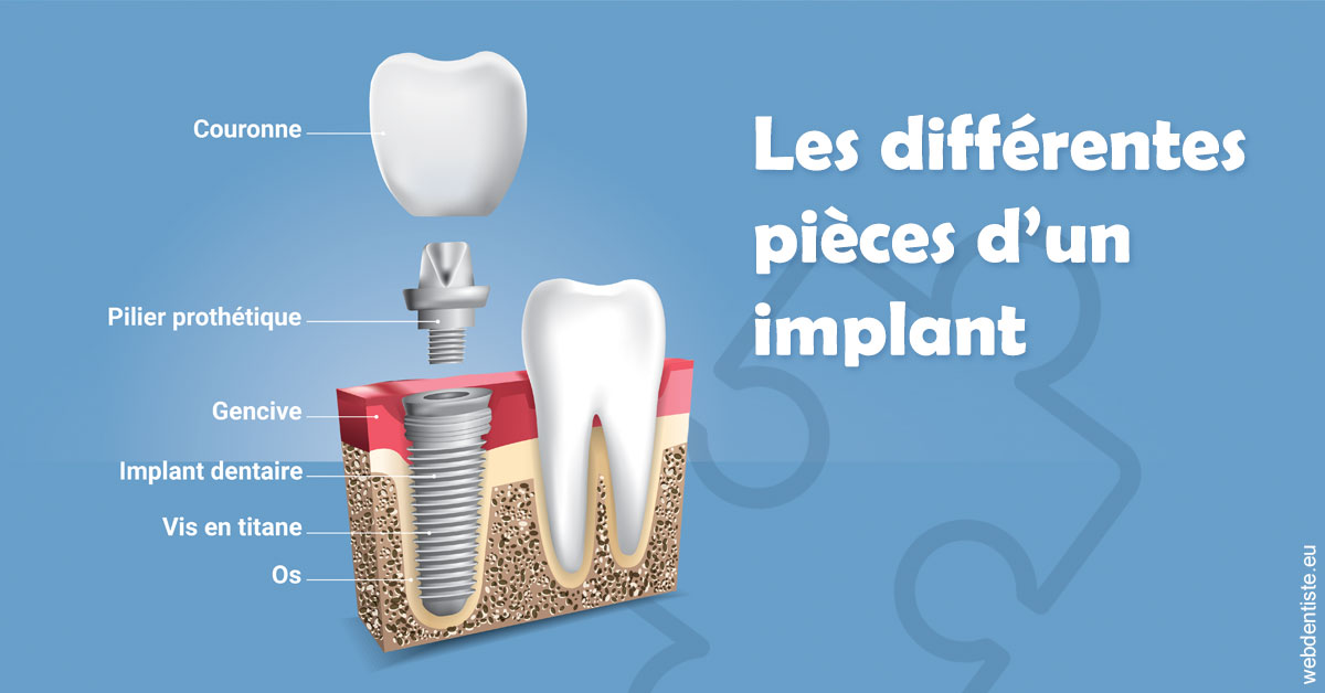 https://dr-sebastien-ginfray.chirurgiens-dentistes.fr/Les différentes pièces d’un implant 1